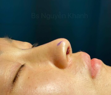 Phương pháp nâng mũi nào thích hợp cho dáng mũi cao nhưng chóp mũi lại thấp