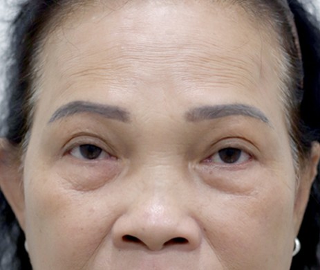 Cắt Mí Dưới + Cấy Mỡ Mí Dưới