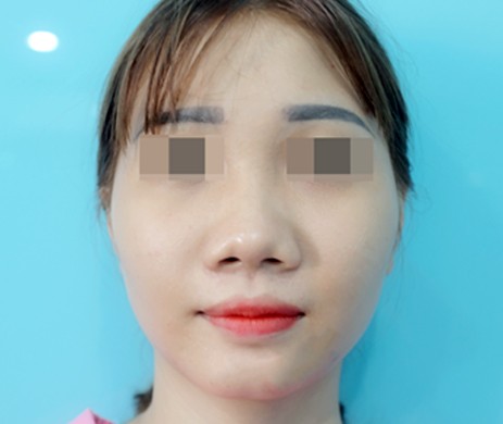 Mũi Cấu Trúc Sụn Sườn – Cà Gồ – Cắt Cánh