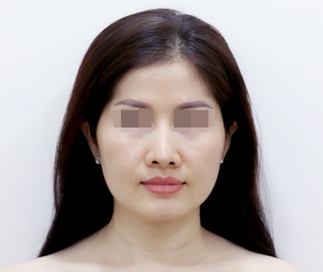 Nâng Mũi Lót Trung Bì Mông