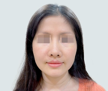 Nâng Mũi Lót Trung Bì Mông