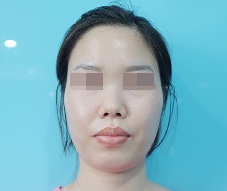 Mũi Cấu Trúc Sụn Sườn – Độn Cằm