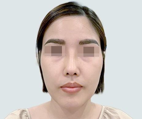 Mũi Cấu Trúc Sụn Sườn – Độn Cằm