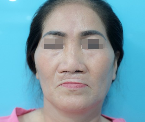 Mũi Cấu Trúc Sụn Sườn – Cắt Xương