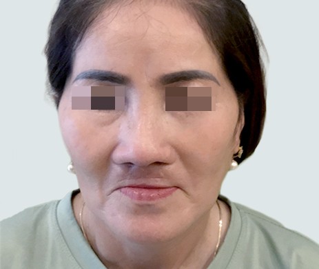 Mũi Cấu Trúc Sụn Sườn – Cắt Xương