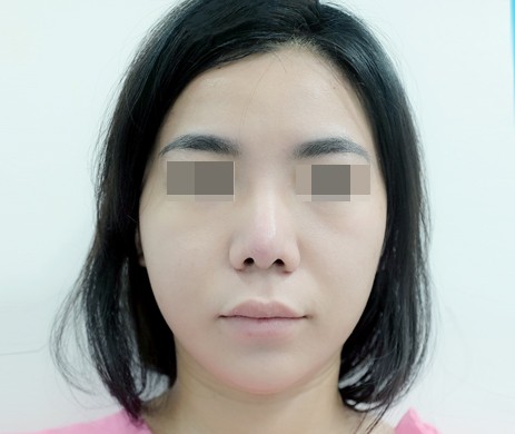 Mũi Cấu Trúc Sửa Lại – Cắt Xương