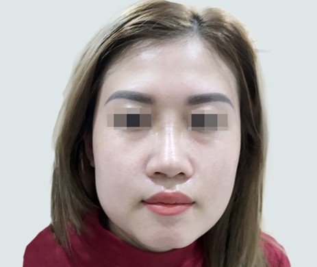 Mũi Lót Sụn – Cắt Xương