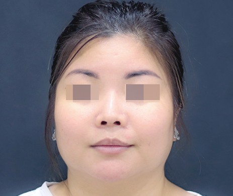 Độn Cằm – Lấy Túi Mỡ Má