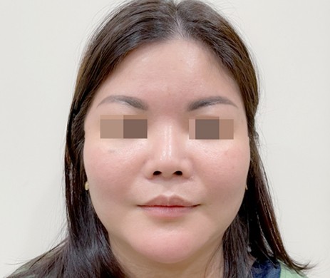 Độn Cằm – Lấy Túi Mỡ Má