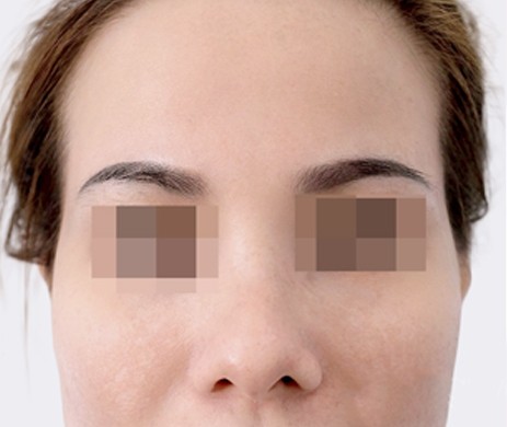 Độn Thái Dương Sau 1 Năm