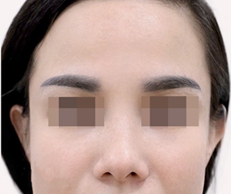 Độn Thái Dương Sau 1 Năm