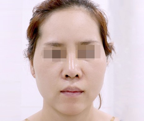 Độn Thái Dương Sau 2 Năm