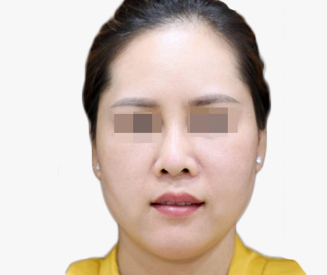 Độn Thái Dương Sau 2 Năm