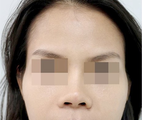 Độn Thái Dương Sau 2 Tháng