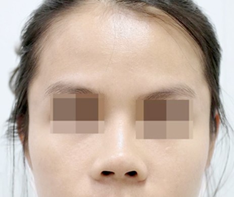 Độn Thái Dương Sau 2 Tháng