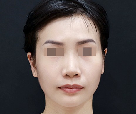 Độn Thái Dương Sau 3 Năm