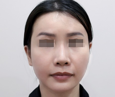 Độn Thái Dương Sau 3 Năm