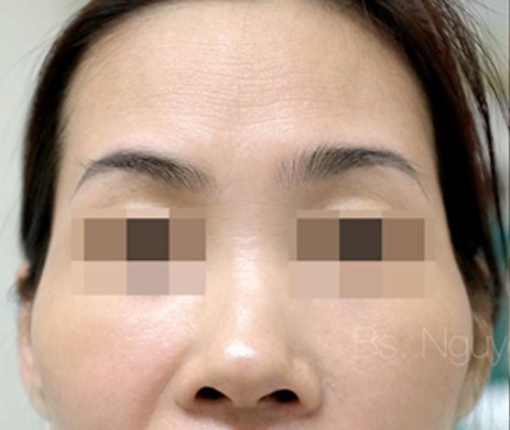 Độn Thái Dương Sau 4 Năm