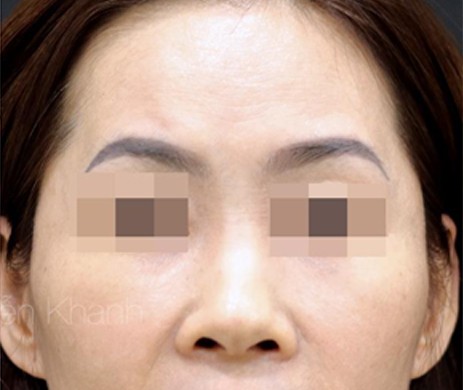 Độn Thái Dương Sau 4 Năm