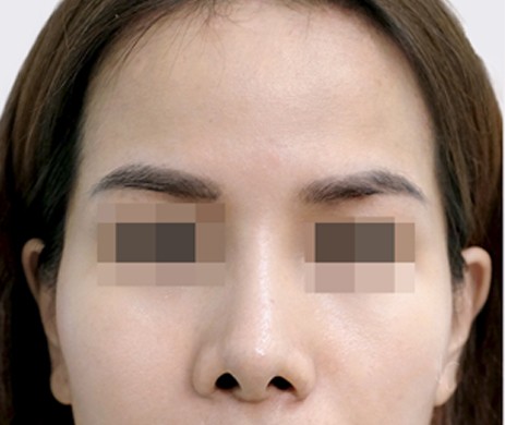 Độn Thái Dương Sau 5 Tháng