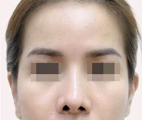 Độn Thái Dương Sau 5 Tháng