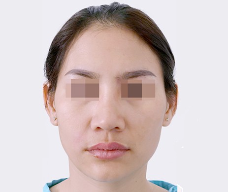 Độn Thái Dương Sau 7 Tháng