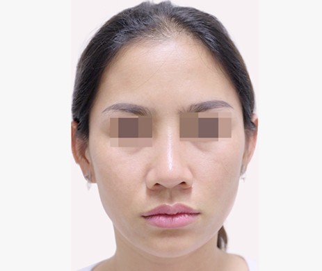 Độn Thái Dương Sau 7 Tháng