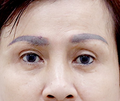 Cấy Mỡ Mí Dưới