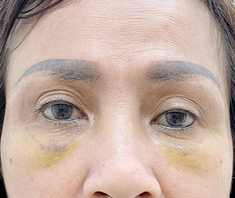 Cấy Mỡ Mí Dưới