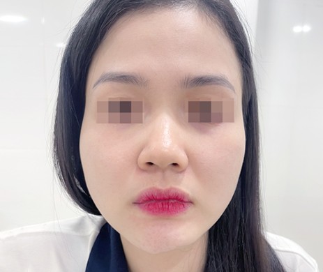 Độn Cằm Sửa Lại 2 Tháng