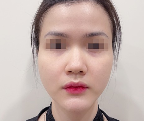 Độn Cằm Sửa Lại 2 Tháng