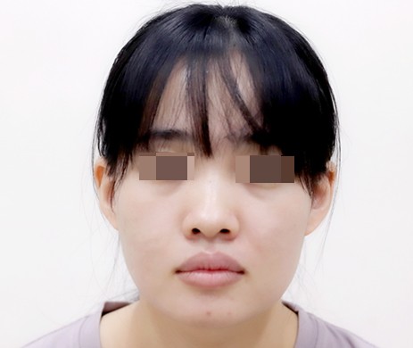 Cắt môi trái tim sau 1 năm