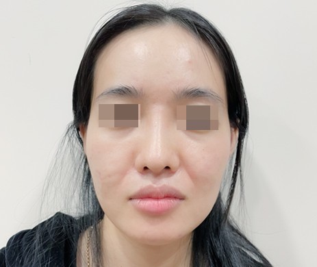 Cắt môi trái tim sau 1 năm