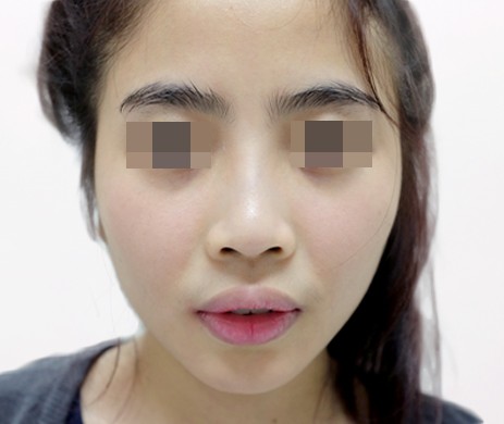 Cắt môi trái tim