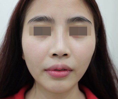 Cắt môi trái tim