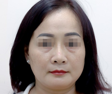 Nâng Mũi Lót Trung bì mông