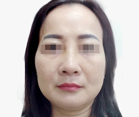 Nâng Mũi Lót Trung bì mông