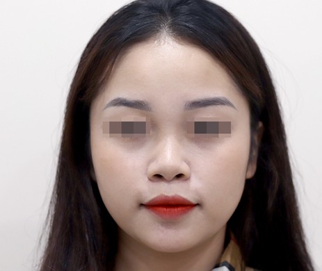 Mũi nhân tạo – Cắt cánh