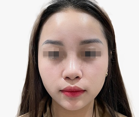 Mũi nhân tạo – Cắt cánh