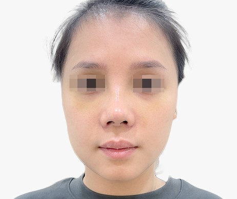 Mũi lót sụn – Cắt cánh mũi – Thu chóp