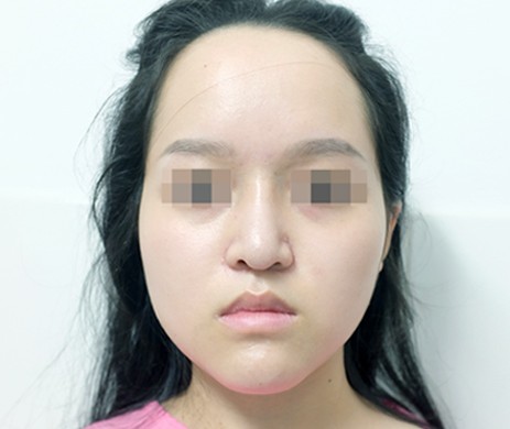 Mũi cấu trúc sụn sườn sửa lại 1,5 năm