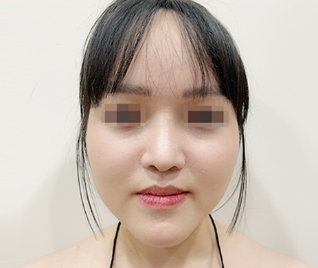 Mũi cấu trúc sụn sườn sửa lại 1,5 năm