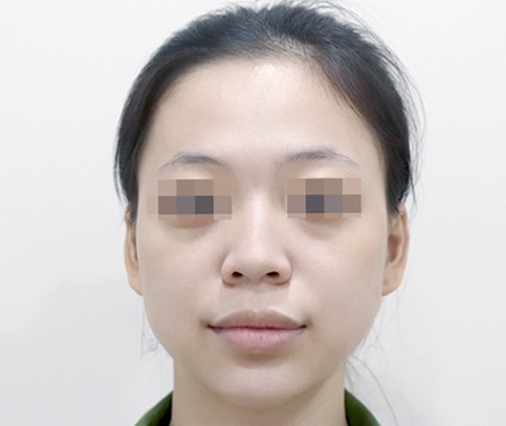 Mũi lót sụn – Cà gồ