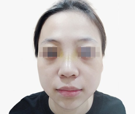 Mũi lót sụn – Cà gồ