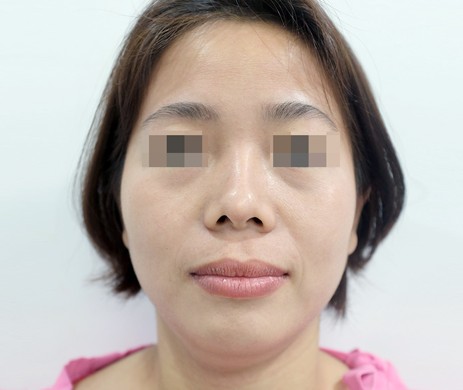 Mũi cấu trúc sụn sườn sửa lại