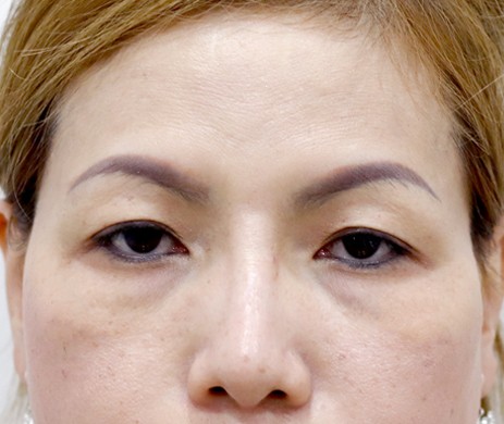 Cắt mí trên mí dưới