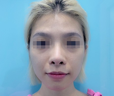 Mũi cấu trúc sụn sườn sửa lại