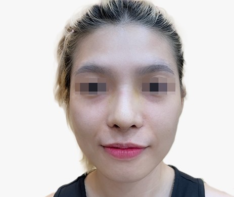 Mũi cấu trúc sụn sườn sửa lại