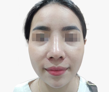 Mũi lót sụn – Cà gồ- Cắt cánh mũi – Thu chóp