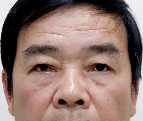 Cắt mí trên mí dưới nam